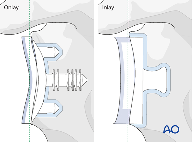 per 10 P300 Revision of an anatomic all polyethylene glenoid component