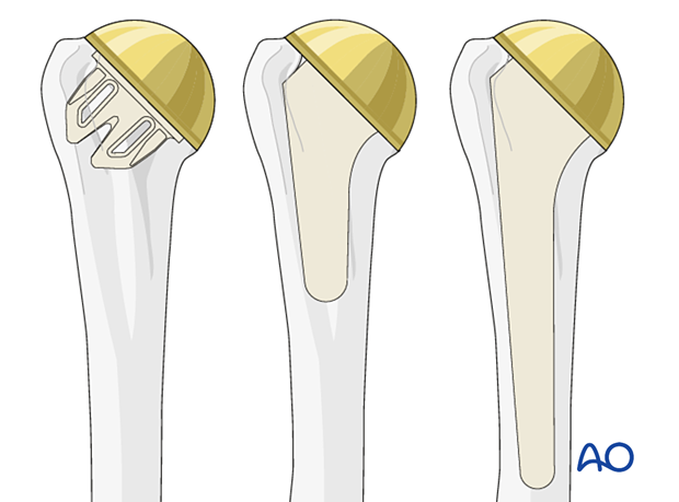 Stemless, short, and standard stems