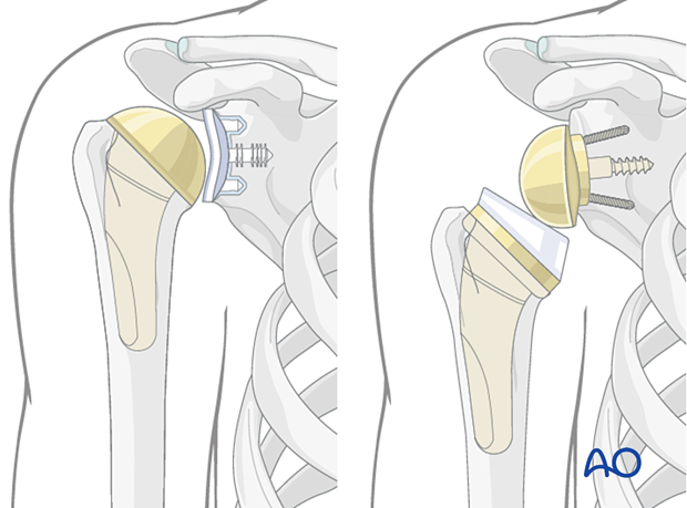 Humeral implants: Anatomic and reverse configuration