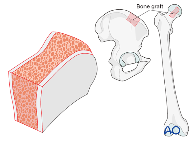 Bone graft