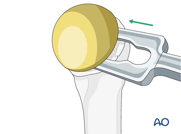 Humeral head removal