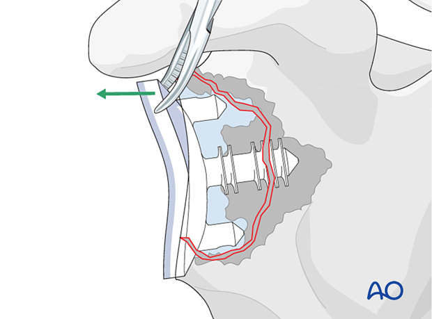 Removal of the glenoid component