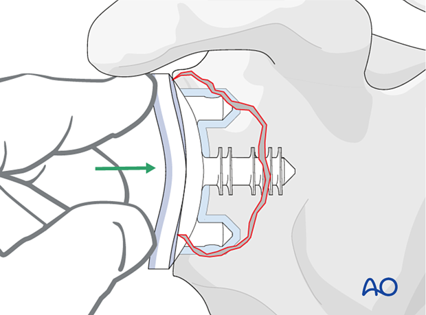 If sufficient bone stock is available implantation of a new anatomical glenoid component can be performed.