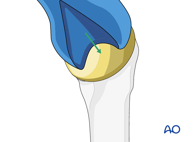 Insertion of a new humeral head component