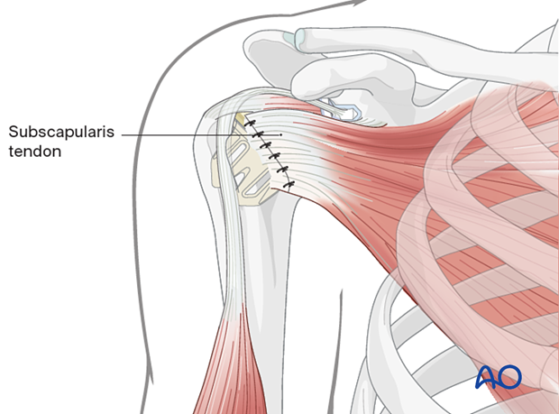 The humerus is reduced, and the subscapularis tendon is reattached