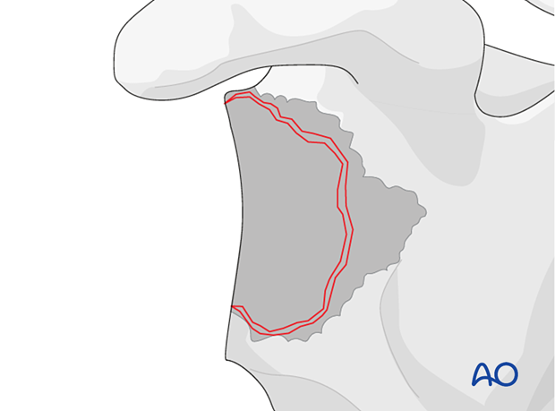 Management of the glenoid bone loss is closely related to the configuration of the remaining glenoid vault.