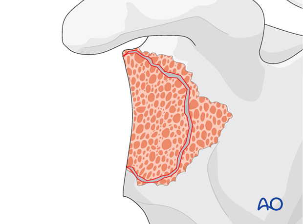 To facilitate stable fixation of a reverse baseplate, it may be necessary to reconstruct the glenoid vault using bone graft.