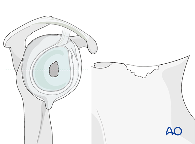 Case of mild glenoid contained defects (Type 1 according to Gohlke)