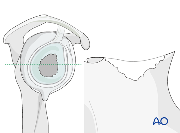 Case of large, contained defects (Type 2 according to Gohlke) 