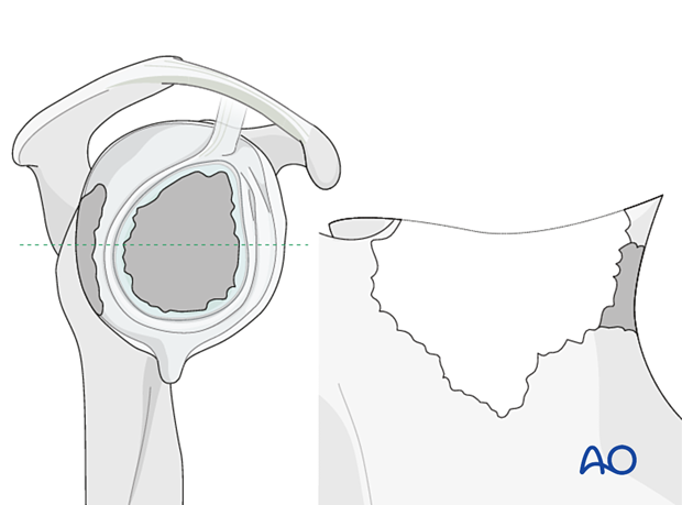 Case of non-contained defects with either anterior or posterior wall insufficiency (Type 3 according to Gohlke