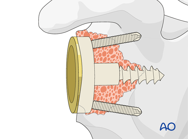 A reverse baseplate with a central screw fixed into native bone with peripheral anti-rotation screws.