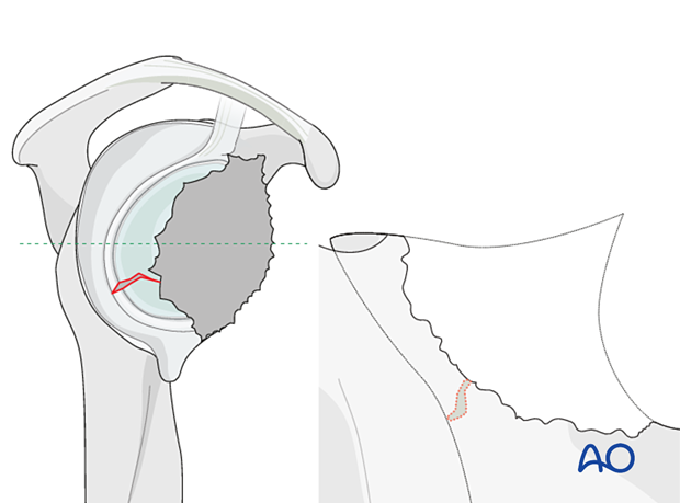 Defects with loss of the glenoid vault (Type 5 according to Gohlke)