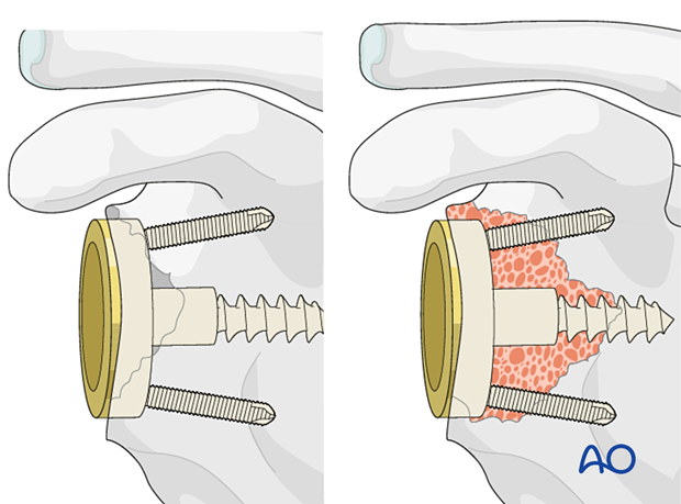 Off-the-shelf augmented base plates may be used in isolation (left) or with bony reconstruction (right)