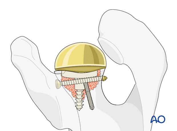 A glenosphere is impacted on the baseplate