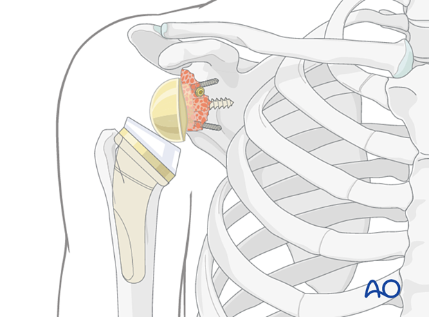 Shoulder reverse implant - final construct