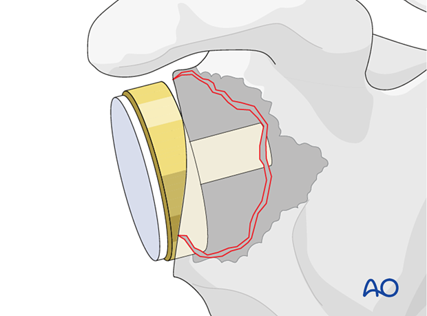 An anatomic metal-backed glenoid component