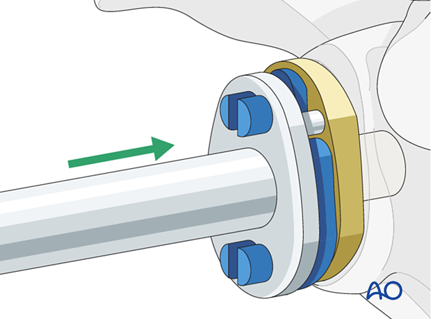 per 10 P310 Revision of an anatomic metal-backed glenoid component