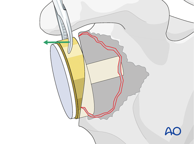 Glenoid exposure and removal