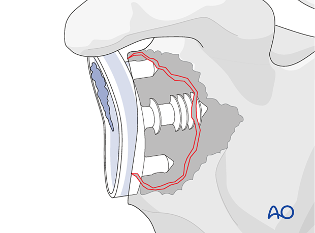 A hybrid glenoid component