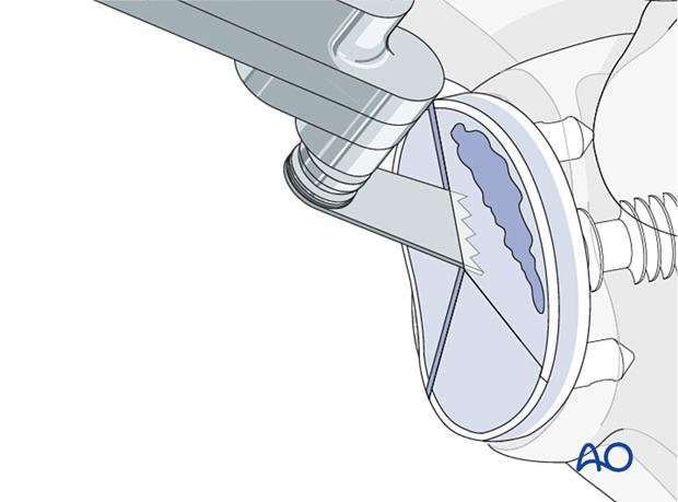 Removal of hybrid component