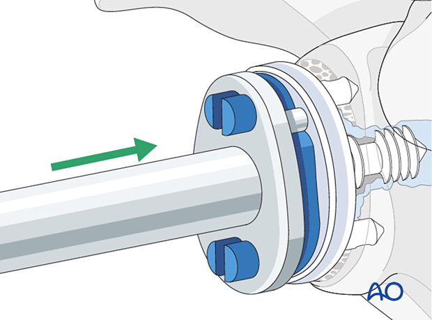 Reimplanting an anatomic glenoid component