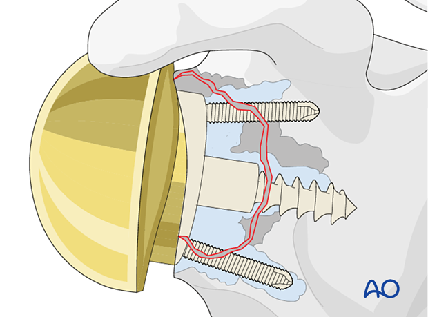 A reverse glenoid baseplate