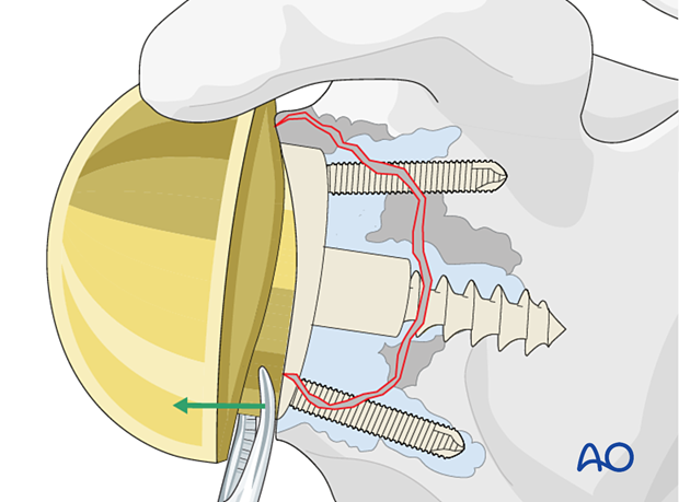 per 10 P340 Revision of a reverse glenoid baseplate