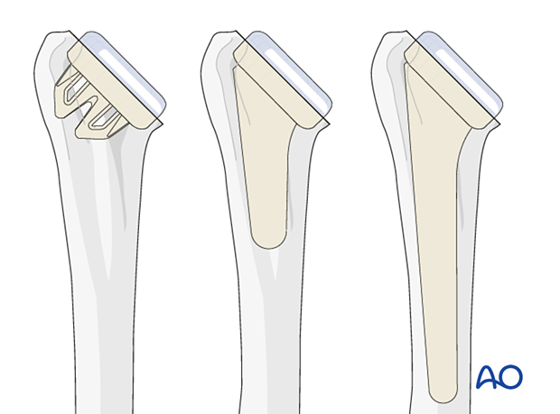 Stemless, short, and standard stems