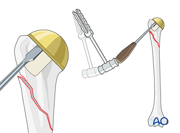 Periprosthetic shoulder fracture - revision of a stemless implant – implant removal