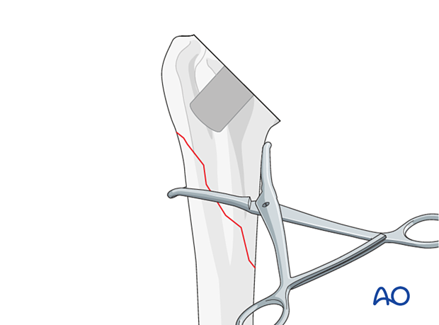 Periprosthetic shoulder fracture - revision of a stemless implant – provisional reduction and holding of the fracture