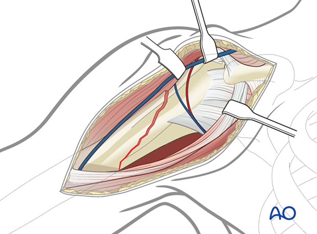 Periprosthetic shoulder fracture – exposing the fracture