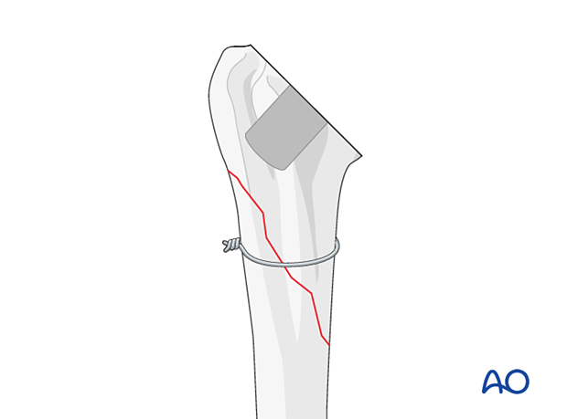 Periprosthetic shoulder fracture – in simple fracture patterns, cerclage cables or wires can be used to maintain the reduction