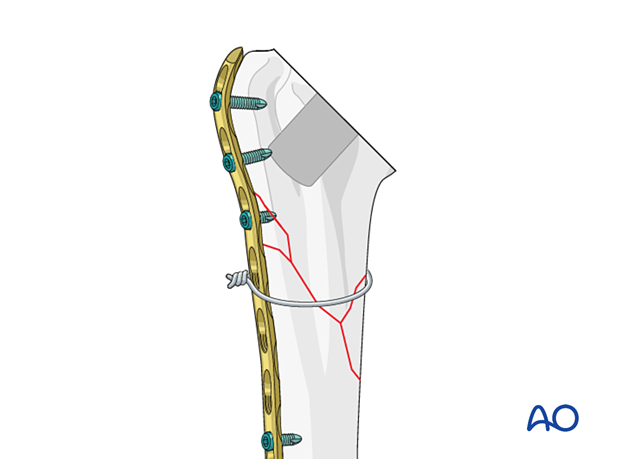 Periprosthetic shoulder fracture – in complex fracture patterns, bridging plate fixation is required to maintain reduction and stability