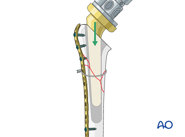 per10 P420 Revision of a short stem