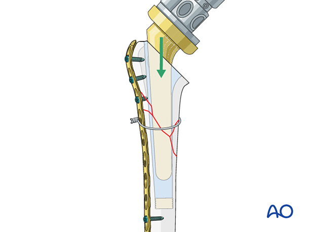 Cemented implantation technique