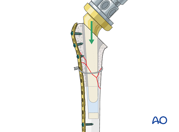 per10 P420 Revision of a short stem