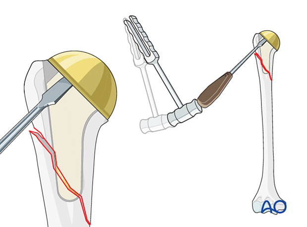 Periprosthetic shoulder fracture - revision of a short stem implant – implant removal