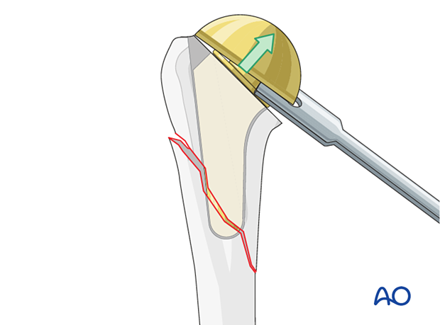 An implant-specific tool is used to remove the head component of a short stem prosthesis