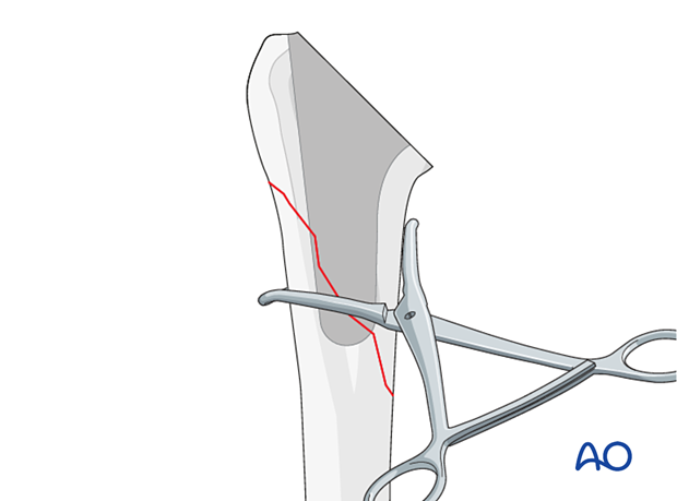 Periprosthetic shoulder fracture - revision of a short stem implant – provisional reduction and holding of the fracture