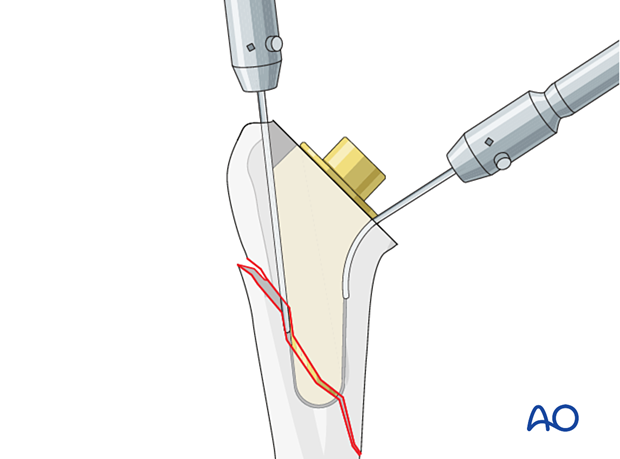 Flexible osteotomes may be helpful when removing a short stem prosthesis