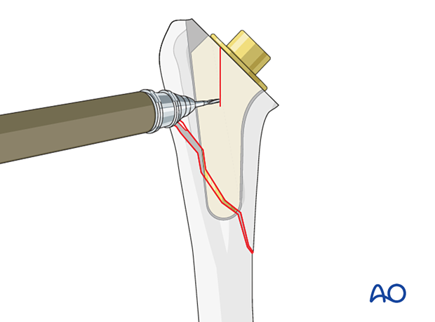 Sometimes, humeral osteotomy is required to remove a short-stem component