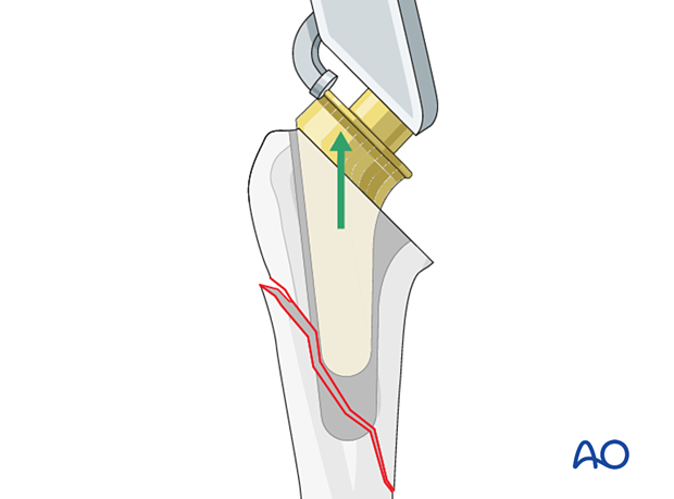 The short stem component is removed