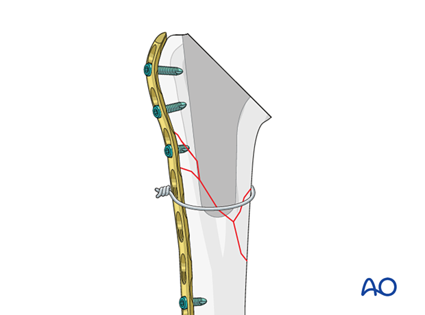 Periprosthetic shoulder fracture - in complex fracture patterns, bridging plate fixation is required to maintain reduction and stability