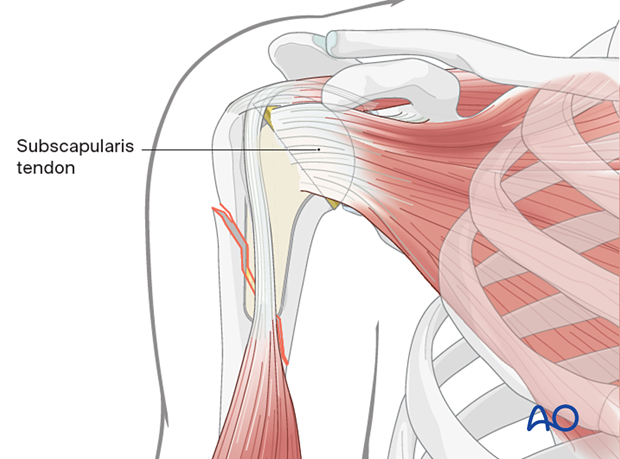 View of shoulder showing short stem prosthesis and subscapularis tendon 