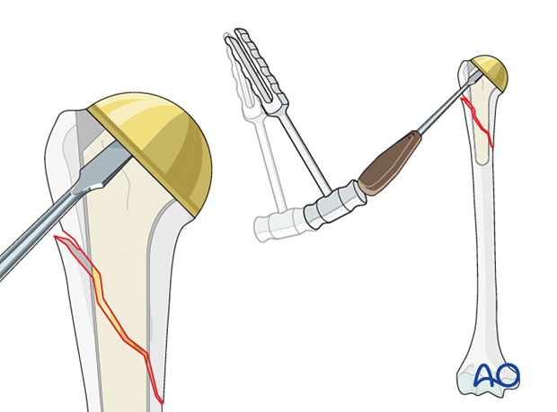 Periprosthetic shoulder fracture - revision of a standard stem implant – implant removal