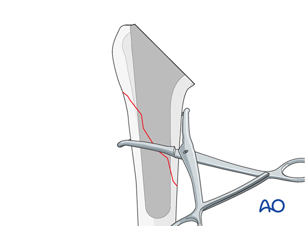 Periprosthetic shoulder fracture - revision of a standard stem implant – provisional reduction and holding of the fracture