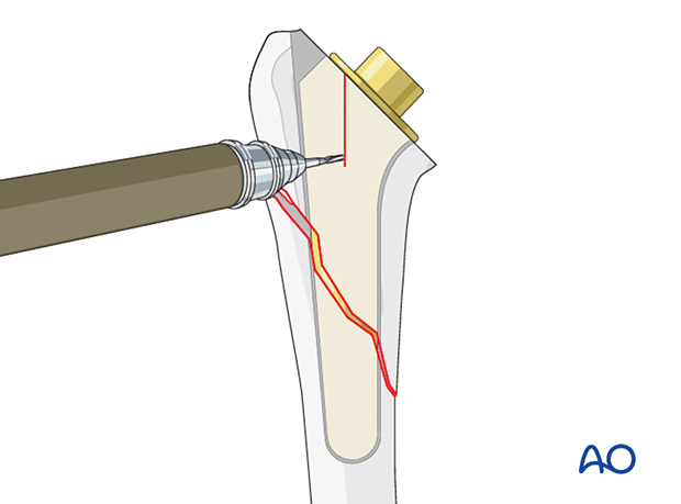 Sometimes, humeral osteotomy is required to remove a standard-stem component