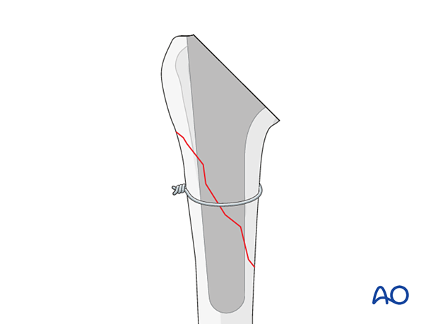 per10 P440 Revision of a standard stem