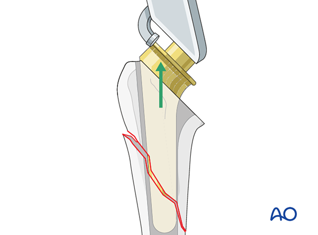 The standard stem component is removed