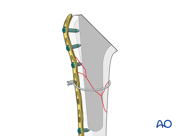 Periprosthetic shoulder fracture – in complex fracture patterns, bridging plate fixation is required to maintain reduction and stability